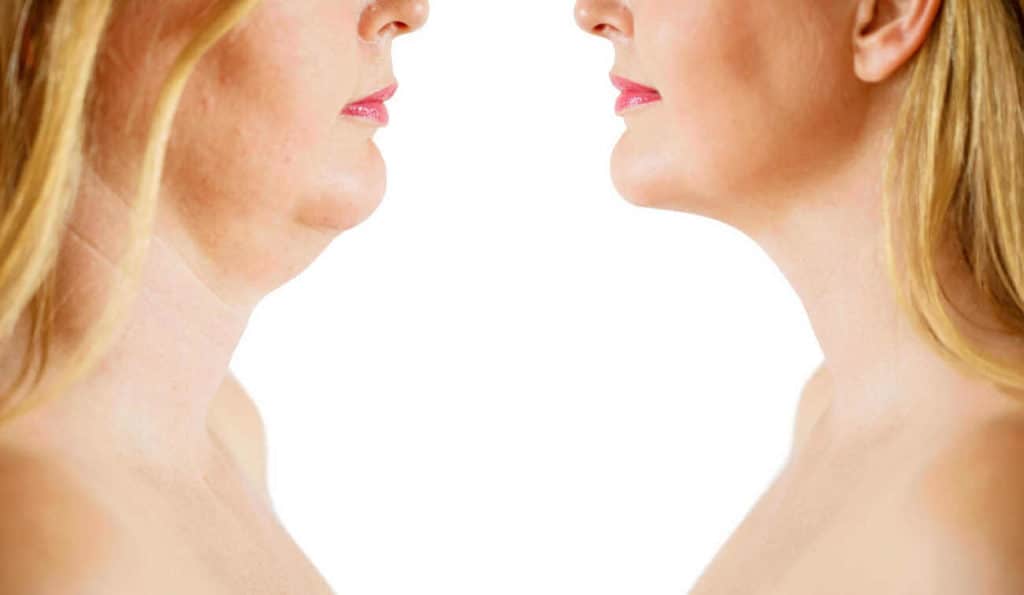 Double Chin treatment Ryton-on-Dunsmore before and after results