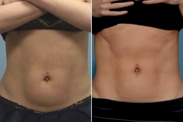 body sculpting FAQs Ryton-on-Dunsmore