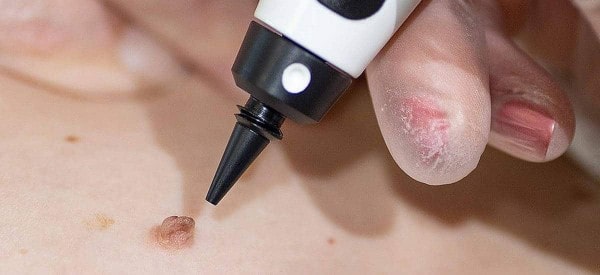 After Skin Tag Removal Ryton-on-Dunsmore