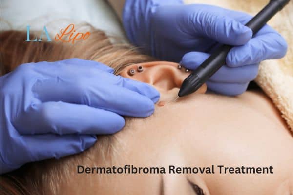 Dermatofibroma Removal Treatment Ryton-on-Dunsmore