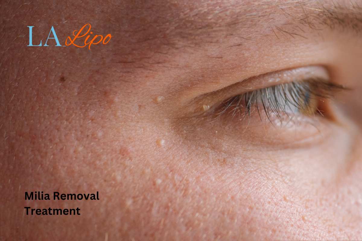 Cryopen Milia Removal: Is It the Easiest and Safest Option Ryton-on-Dunsmore?