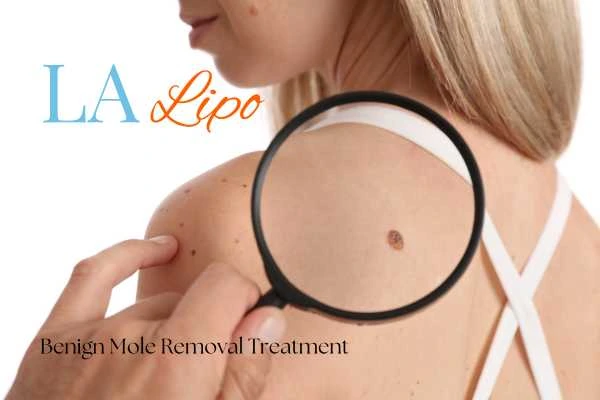 Woman having her inspection of blemish before mole removal Ryton-on-Dunsmore