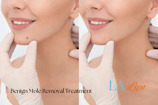 woman's before and after mole removal Ryton-on-Dunsmore results