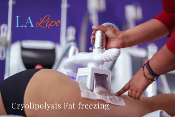 women getting fat freezing Ryton-on-Dunsmore
