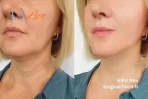 hi-fu for wrinkles Ryton-on-Dunsmore before and after results