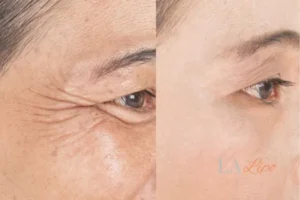 Before and after results of woman - HI-fu wrinkles reduction treatment Ryton-on-Dunsmore