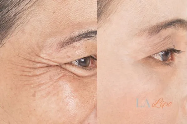 Before and after results of woman - HI-fu wrinkles reduction treatment Ryton-on-Dunsmore