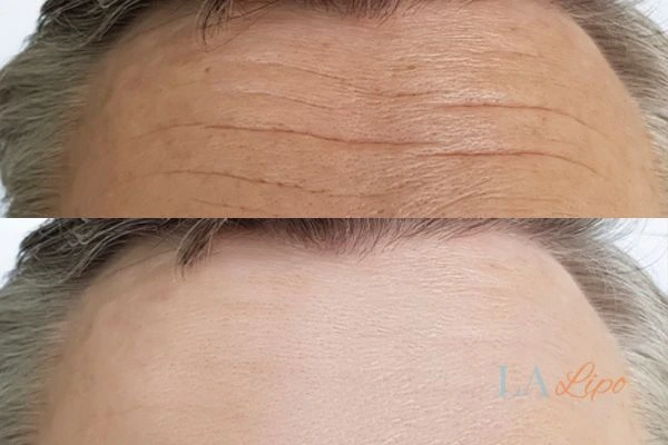 results of HIFU Ryton-on-Dunsmore on mans forehead to help reduce lines and wrinkles