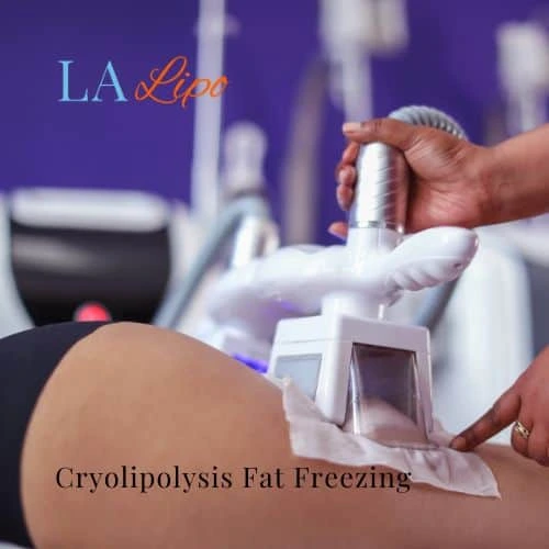 fat freezing - Cryolipolysis Ryton-on-Dunsmore