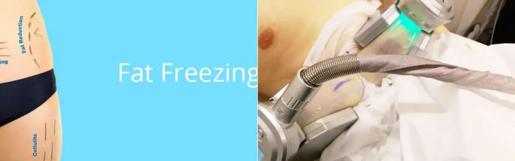Fat freezing Ryton-on-Dunsmore on multiple areas of the body