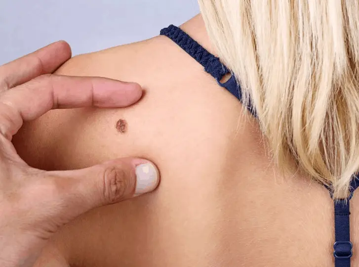 woman having mole removal Ryton-on-Dunsmore consultation before treatment.