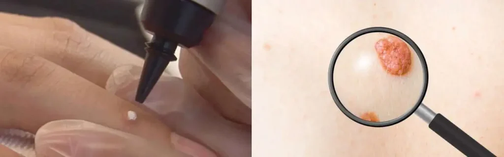 Cryopen for mole removal Ryton-on-Dunsmore - speak to our team today!