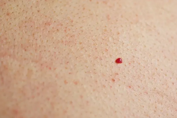close up of a cherry angioma Ryton-on-Dunsmore