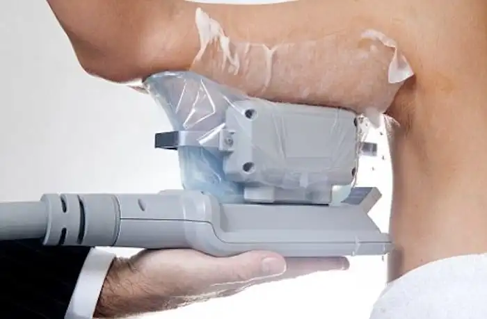 Picture of fat freezing Ryton-on-Dunsmore on the upper arms.