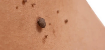 image of a skin tag Ryton-on-Dunsmore