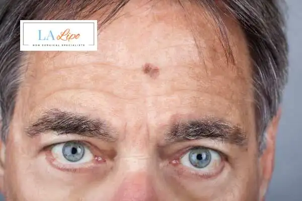 Solar Lentigo Removal Ryton-on-Dunsmore image of man with mark on his forehead