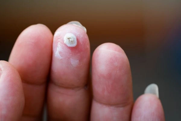 wart on person finger - cryotherapy to treat from LA LIPO Ryton-on-Dunsmore