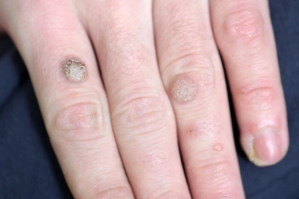 photo of warts on person hand - see wart removal Ryton-on-Dunsmore from LA LIPO
