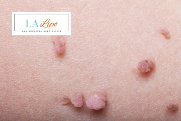 Does cryopen skin tag removal Ryton-on-Dunsmore hurt? Find out now call our team today!