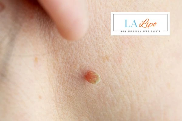 Book skin tag removal Ryton-on-Dunsmore today speak to our team now!