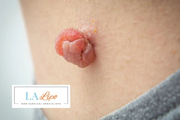 Interested in skin tag removal Ryton-on-Dunsmore? Concerned about the pain? Find out more today!