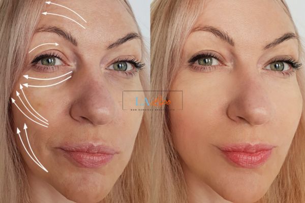 Morpheus 8 results Ryton-on-Dunsmore face lift.