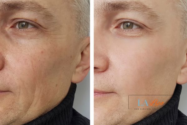 See the amazing results of Morpheus8 Treatment Ryton-on-Dunsmore!