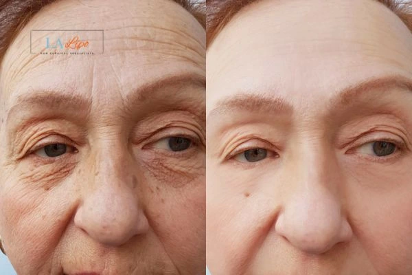 The powerful benefits of Morpheus8 Treatment Ryton-on-Dunsmore - Call Our team today!