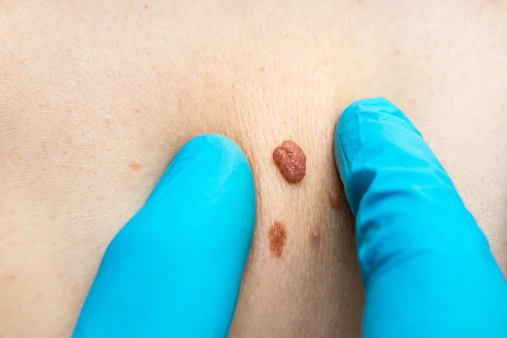 LA LIPO Cryopen Lesion Removal Prices Ryton-on-Dunsmore