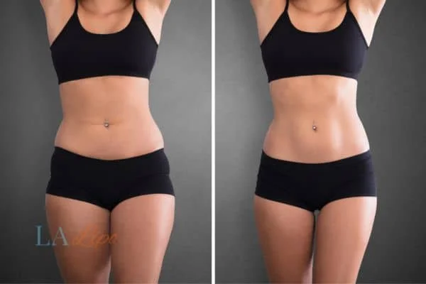 before and after results of non-surgical treatment to help a woman's body image and mental health Ryton-on-Dunsmore