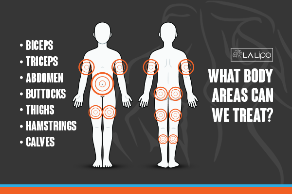 Diagram to show areas you can have LA-EMS Body Sculpting Treatment Ryton-on-Dunsmore