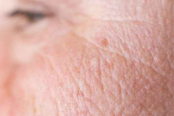 close up picture of a woman's face showing an age spot Ryton-on-Dunsmore