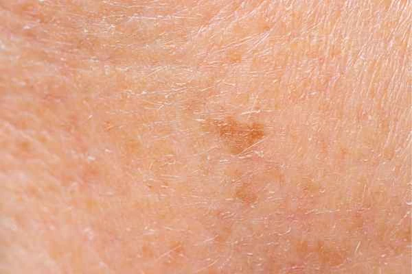 close up picture of age spots Ryton-on-Dunsmore