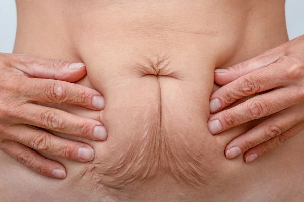 Image of a woman's stomach with loose skin - example of skin tightening Ryton-on-Dunsmore options