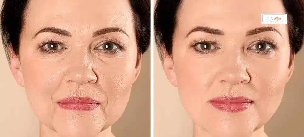 How Long Does It Take to See Results and How Long Do They Last Ryton-on-Dunsmore?
