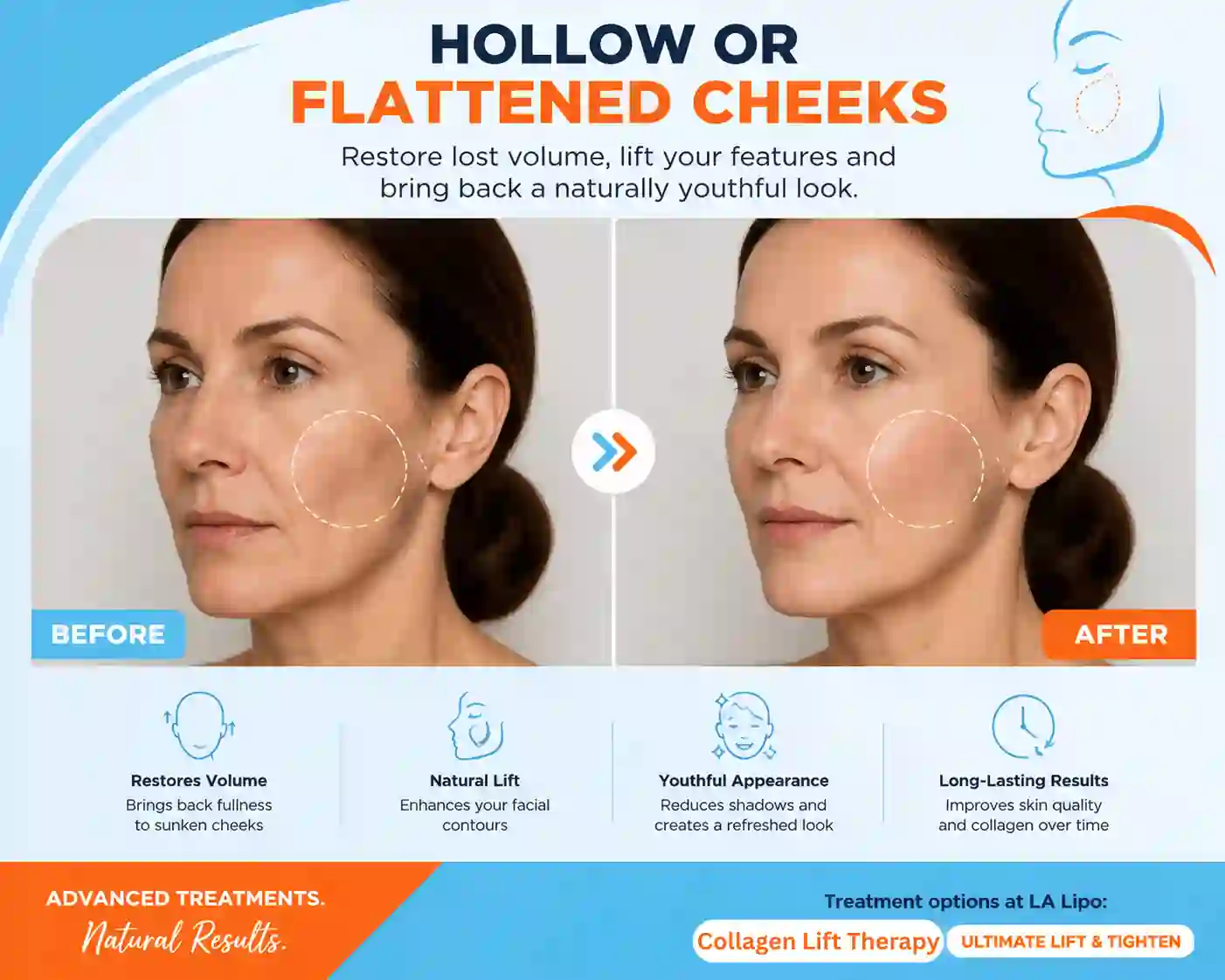 Sign #4: Hollow or Flattened Cheeks Ryton-on-Dunsmore