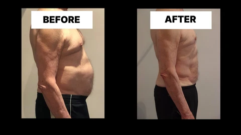 What Symptoms Can Diastasis Recti Cause in Men? Weak Core, Back Pain and Poor Posture Ryton-on-Dunsmore